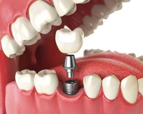 dental-implants-2