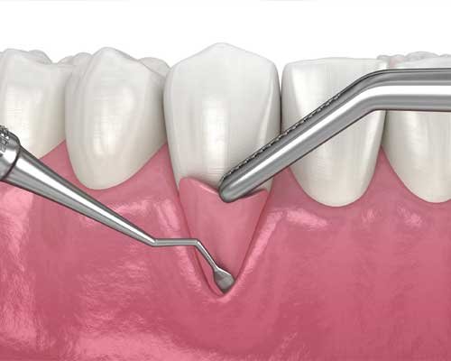 gum-treatment