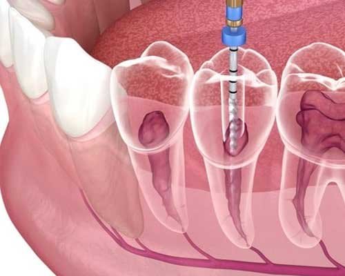 root-canal-treatment-2