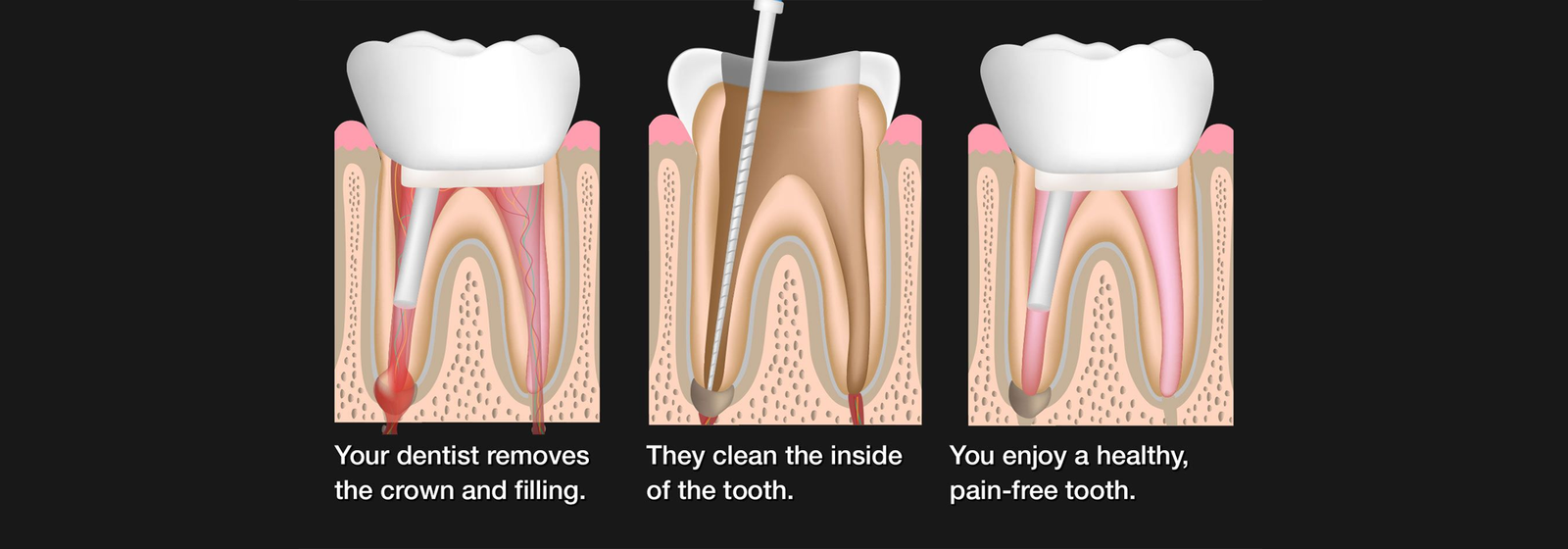 rootcanal